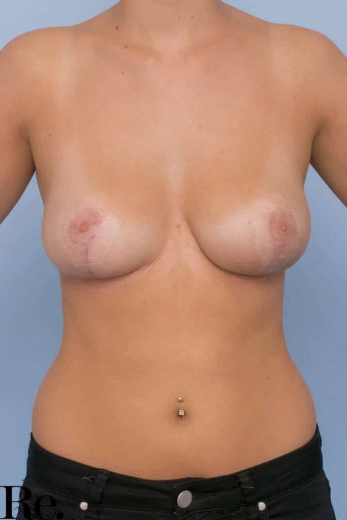 00072 6 Re Gallery Breast Lift 683x1024