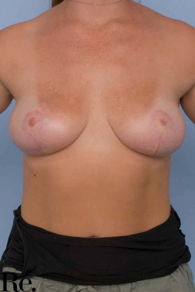 00073 6 Re Gallery Breast Lift 1 683x1024