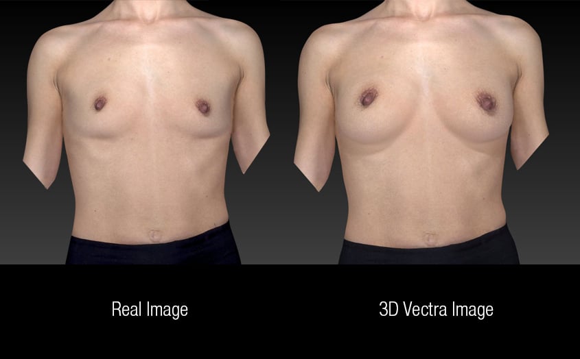 Discover what Your Breasts Could Look Like After Surgery
