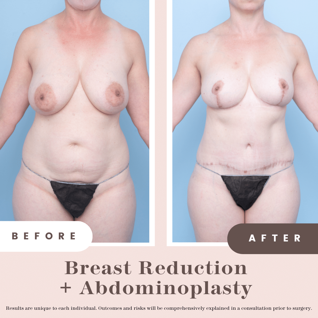 Abdominoplasty + Breast Reduction