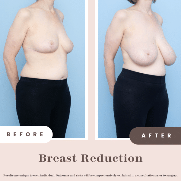 Before and after
