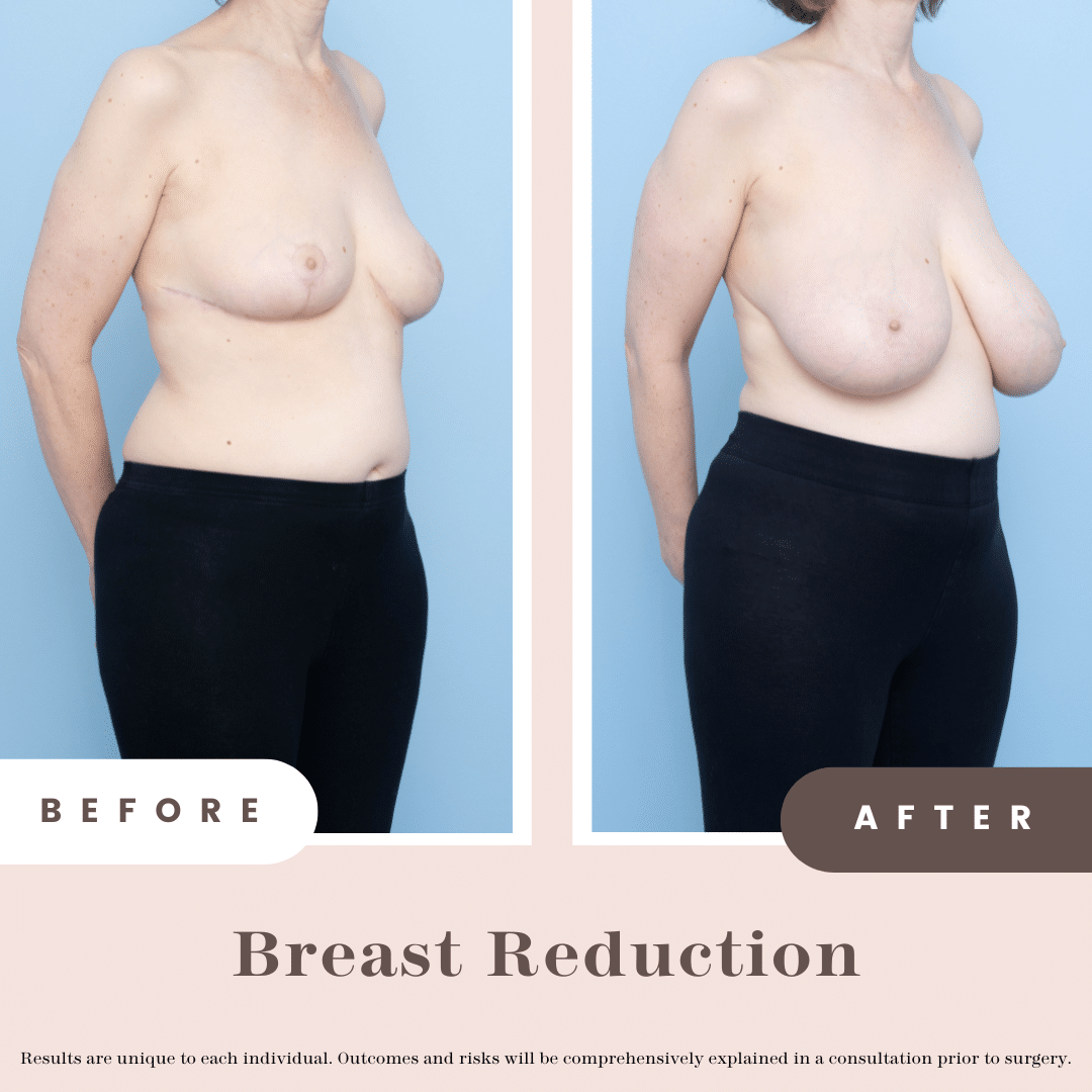 Before and after
