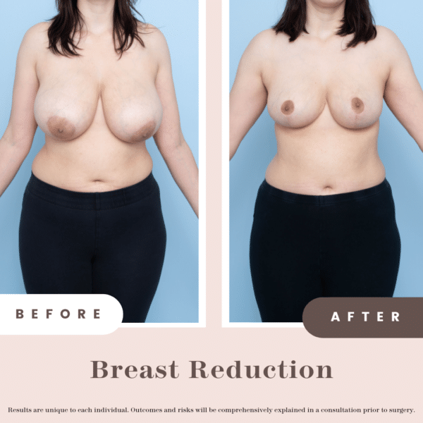 Breast Reduction