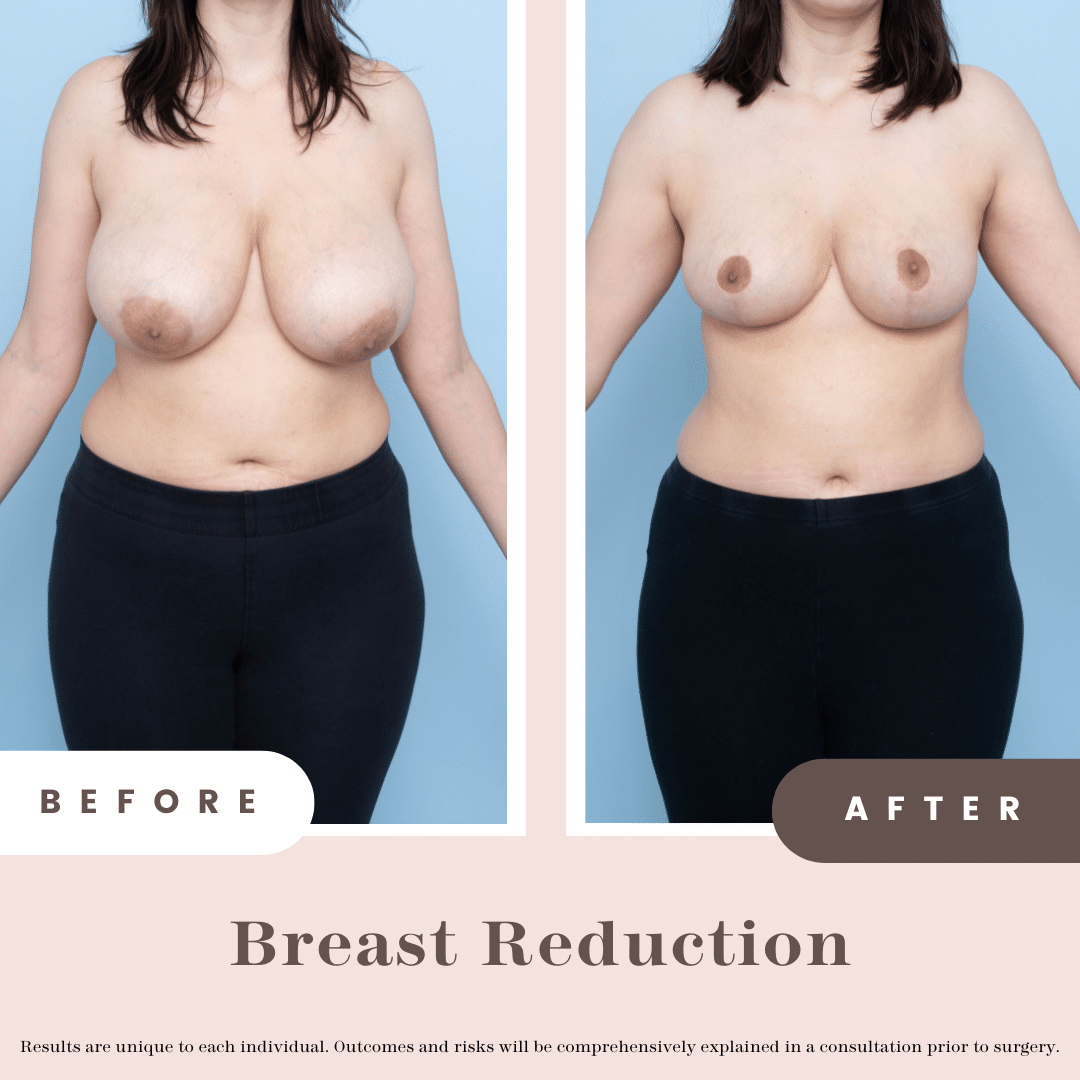 Breast Reduction