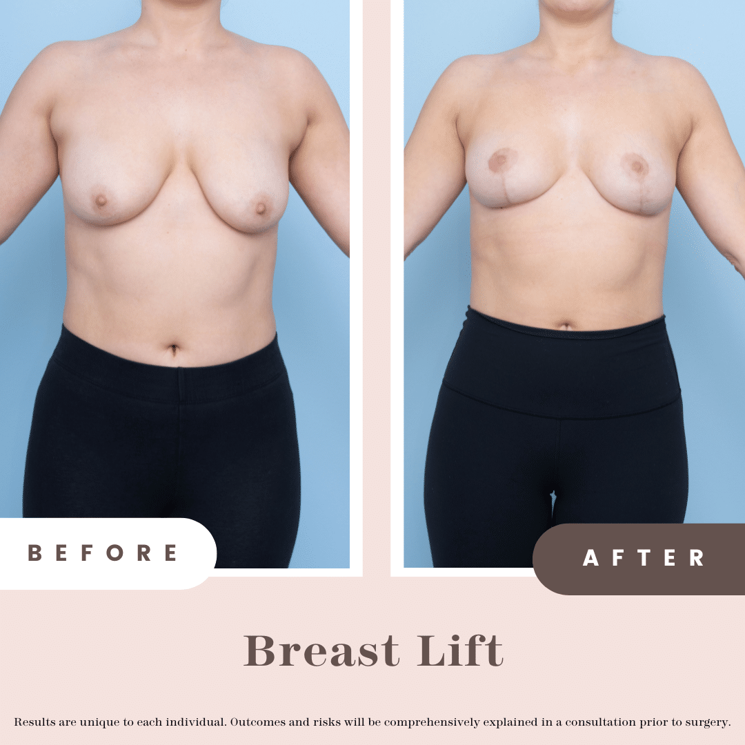 Breast lift