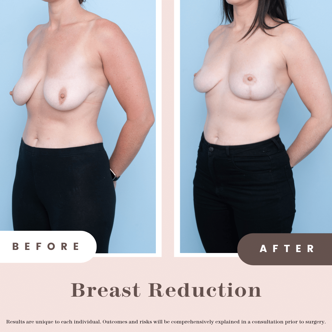 Breast Reduction Before and After