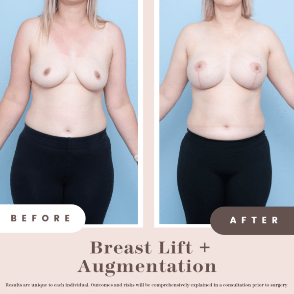 Breast Lift + Augmentation Composite (1)