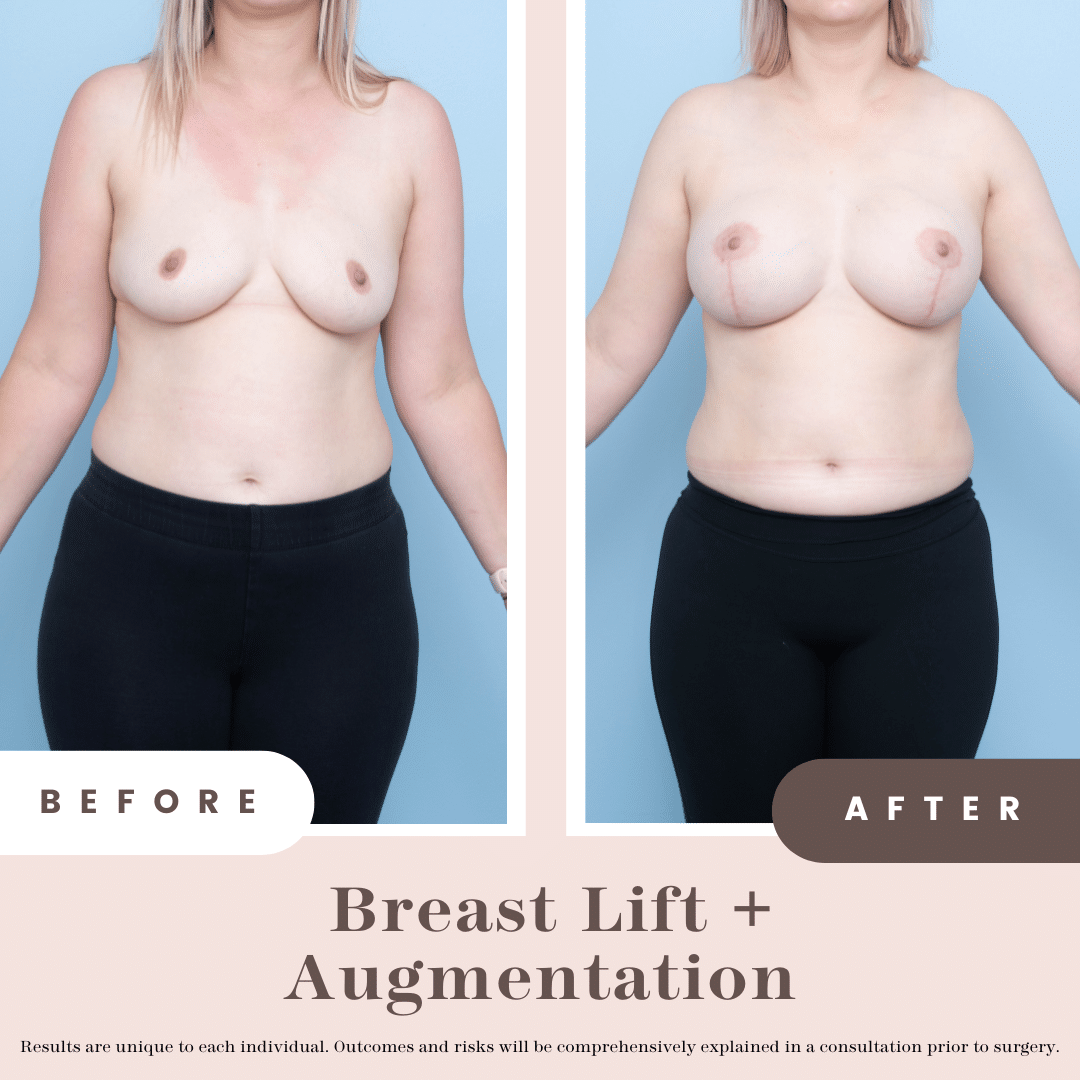 Breast Lift + Augmentation Composite (1)